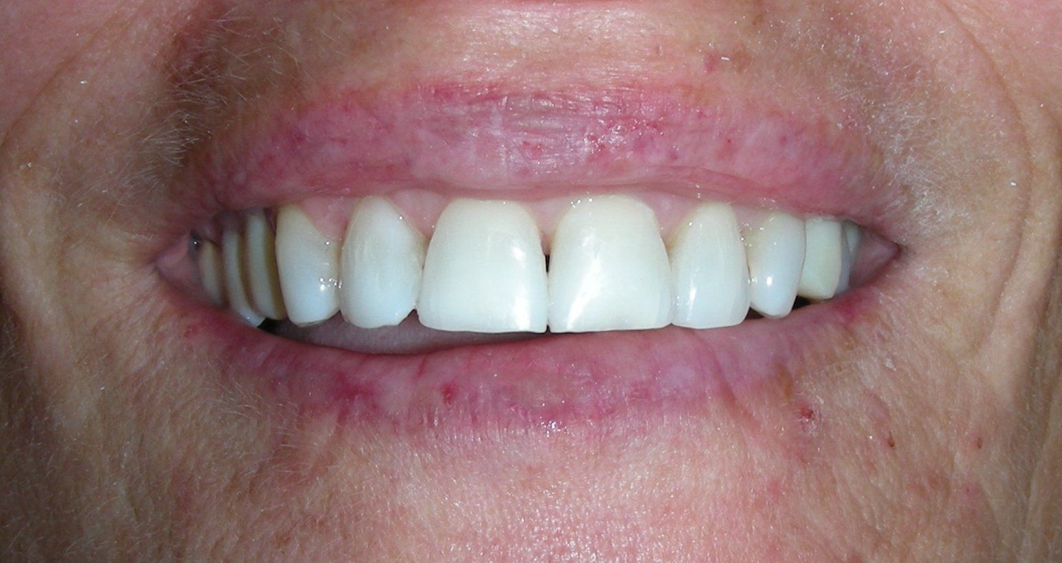 Dental bonding correcting dark line through teeth