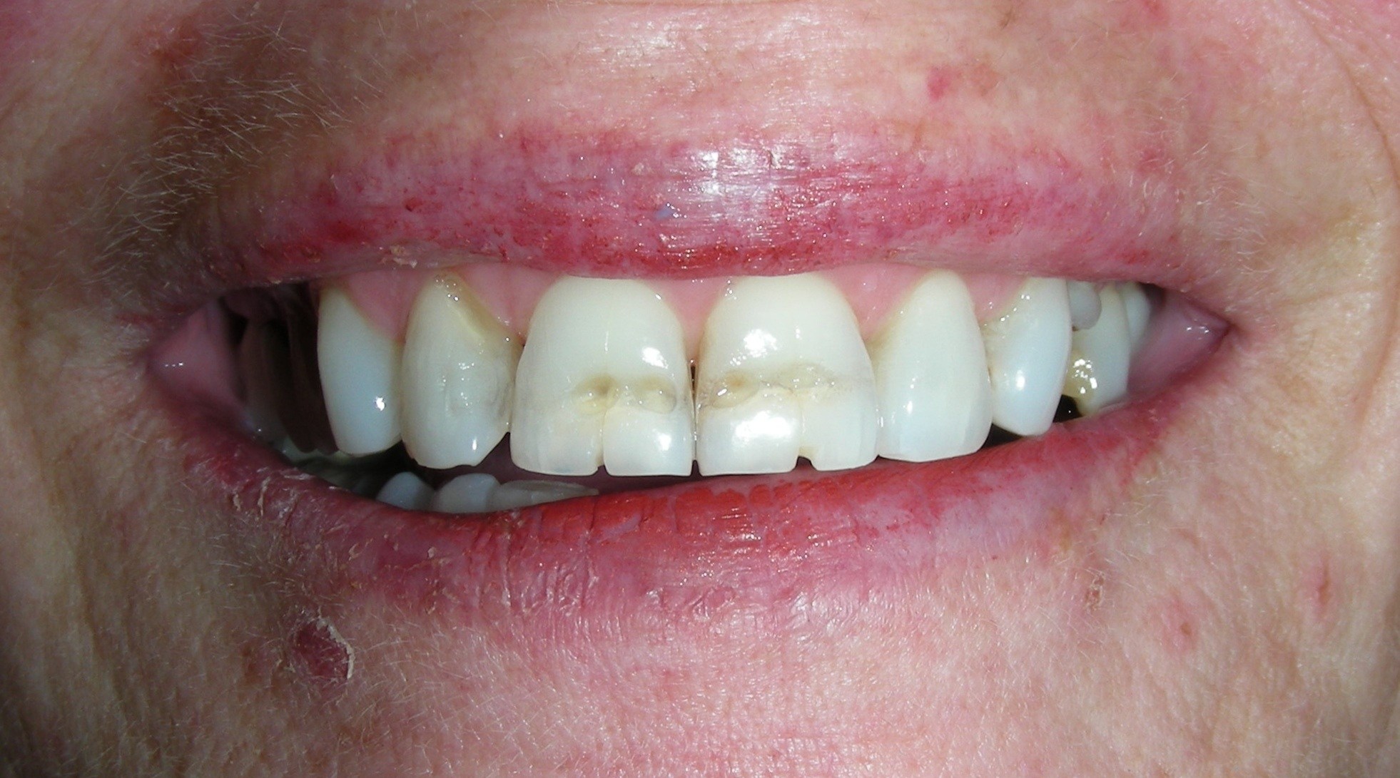 Dark line across the center of top front teeth