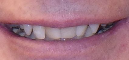 Dark colored top front teeth