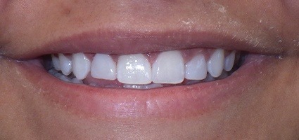 Teeth repaired with dental bonding