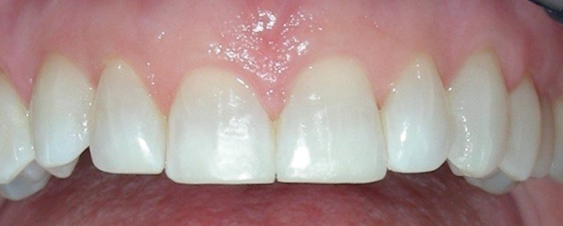 Dental bonding repairing tooth wear