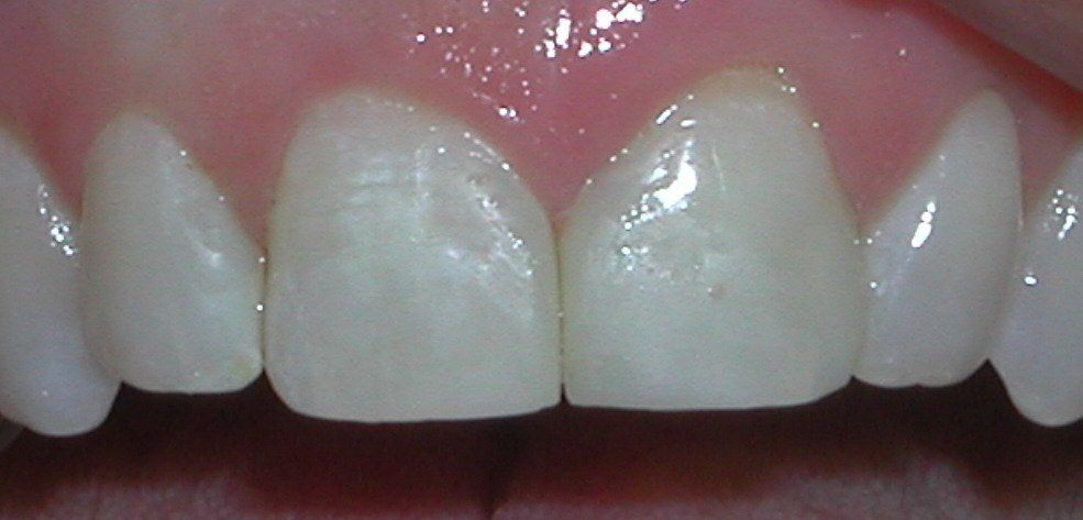 Dental bonding repairing chipped teeth