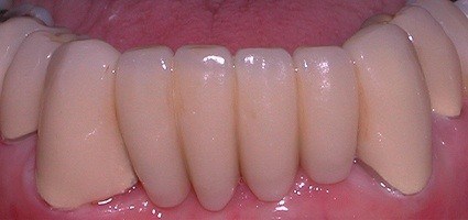 Closeup of smile with tooth colored restorations