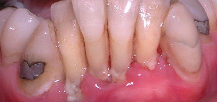 Closeup of teeth with decay and dark colored restorations