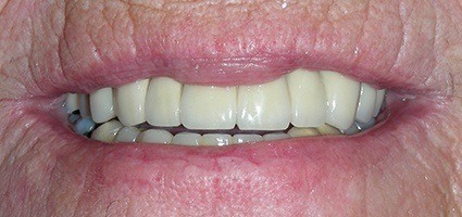 Flawlessly restored top teeth