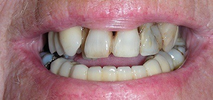 Decayed and damaged top teeth