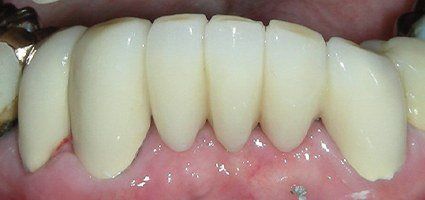 Flawlessly repaired teeth