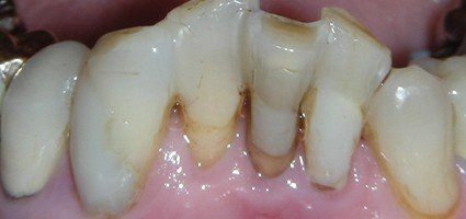 Severely decayed and damaged teeth