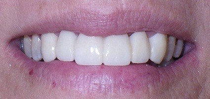 Perfectly restoreed smile after treatment