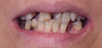 Decayed and missing teeth prior to treatment