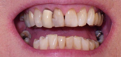 Damaged and discolored top teeth