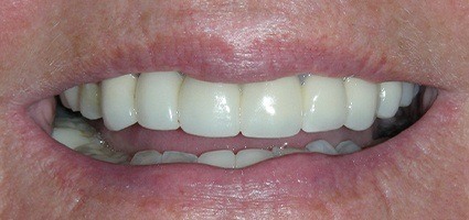 Seamlessly replaced top teeth