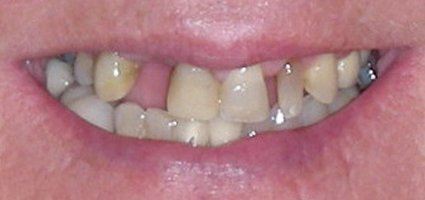 Several missing top teeth