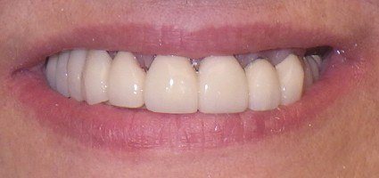 Completely restored smile after treatment