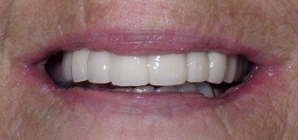 Repaired top teeth after treatment