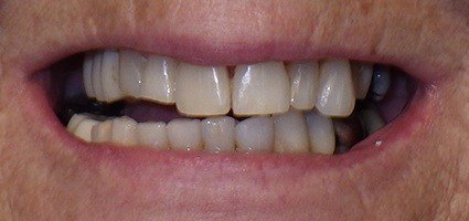 Damaged top teeth before treatment