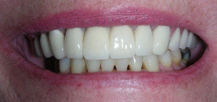 Gap closed between top teeth