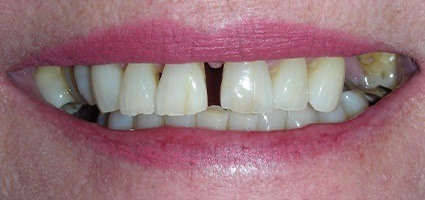 Gap between top teeth