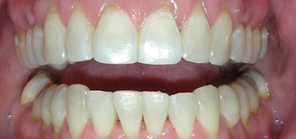 Flawless smile after treatment