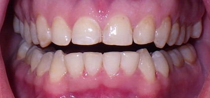 Flawless smile after treatment