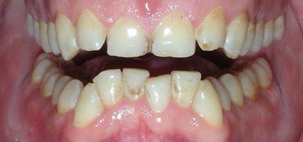 Crooked teeth prior to alignment