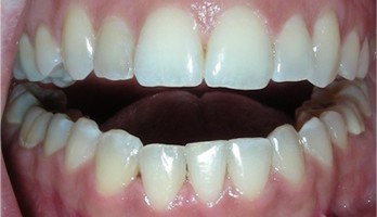 Flawless smile after treatment