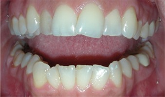 Crooked teeth prior to alignment