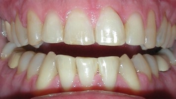 Flawless smile after treatment