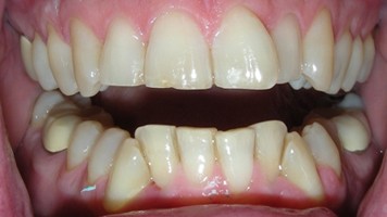 Crooked teeth prior to alignment