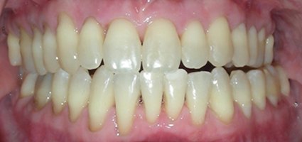 Flawless smile after treatment