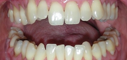 Crooked teeth prior to alignment