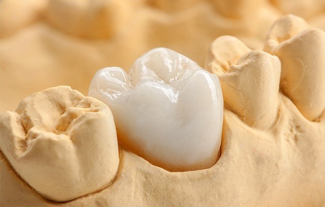 Model of the mouth with a dental crown covering one of the teeth