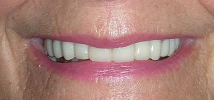 Dental crown repairing teeth and closing gap