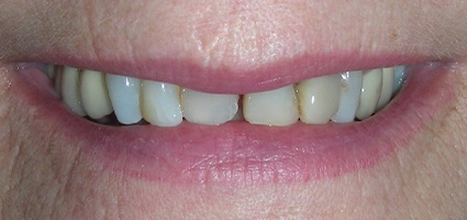 Damged top teeth with large gap