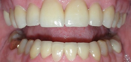 Closeup of dental crowns restoring yellow and worn teeth