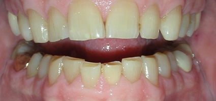 Yellow and worn teeth before treatment