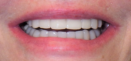 Damaged teeth repaired with dental crowns