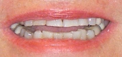 Teeth damaged from wear