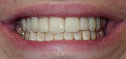 Smile repaired dental crowns