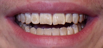 Damaged teeth