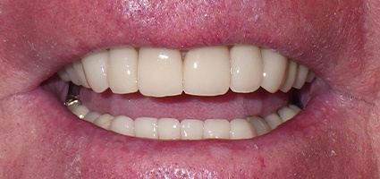 Front teeth repaired with dental crowns