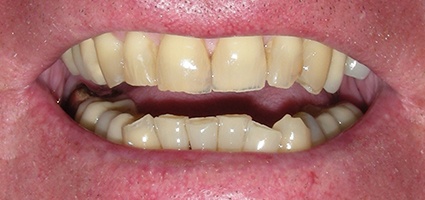 Severely decayed and worn front teeth