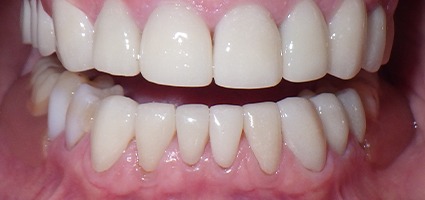 Bottom teeth repaired with dental crowns