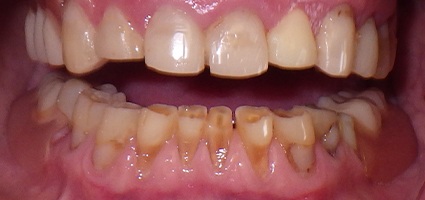 Decayed and damaged bottom teeth