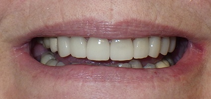 Dental crowns over top front two teeth