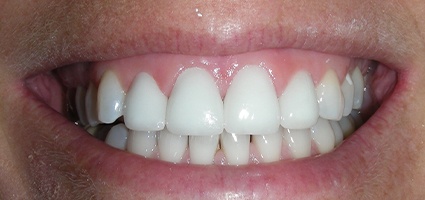 Dental crowns closing gap between top teeth