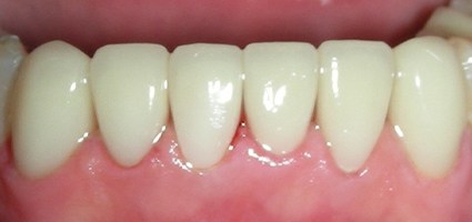 Dental crowns repairing worn bottom teeth