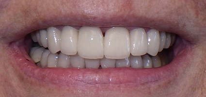 Natural looking dental restorations