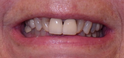 Discolored and damaged dental restorations