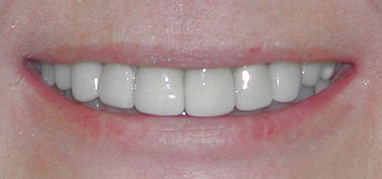 Dental crowns repairing worn front teeth